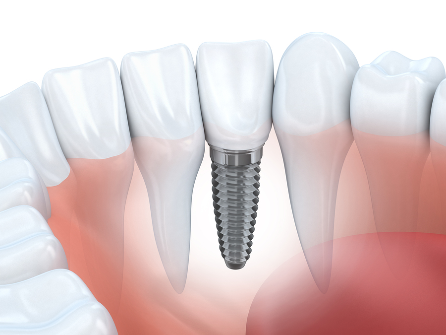dental implants Novi, MI