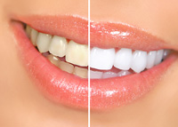 before and after results teeth whitening Novi, MI